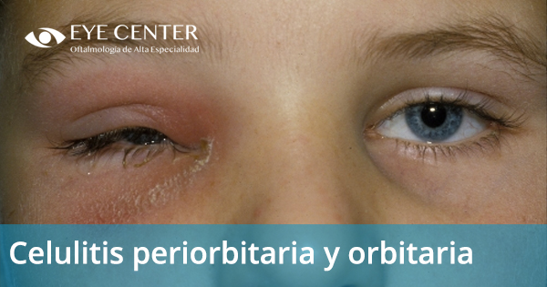 Celulitis periorbitaria y orbitaria