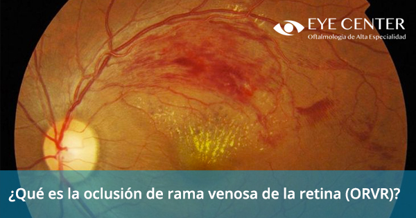 ¿Qué es la oclusión de rama venosa de la retina (ORVR)?