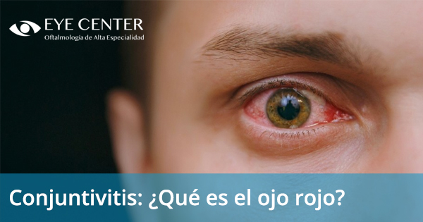 Conjuntivitis: ¿Qué es el ojo rojo?