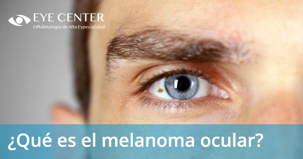 ¿Qué es el melanoma ocular?