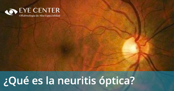 ¿Qué es la neuritis óptica?