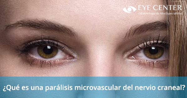 ¿Qué es una parálisis microvascular del nervio craneal?