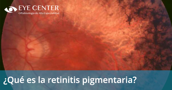 ¿Qué es la retinitis pigmentaria?