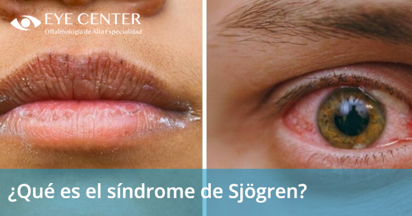 ¿Qué es el síndrome de Sjögren?